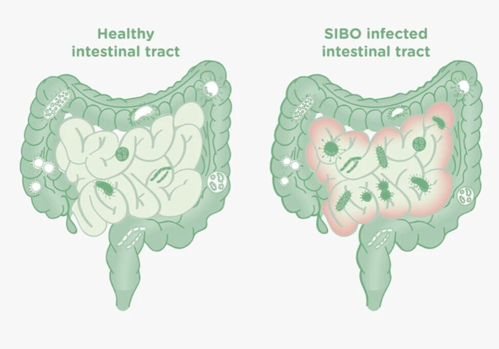 SIBO